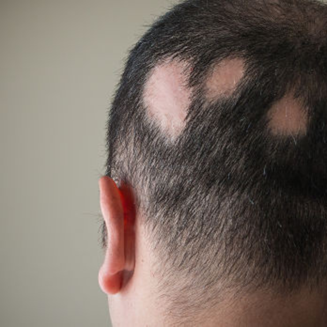 Alopecia Areata