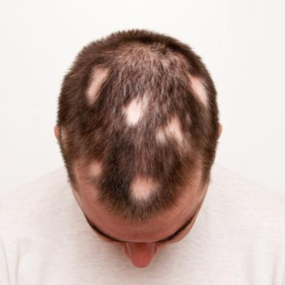 Alopecia Areata causes