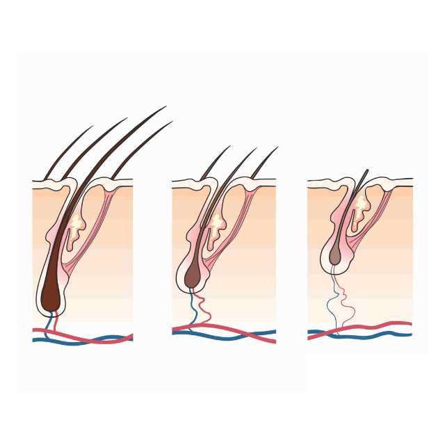 Male hair loss hair follicle miniaturisation